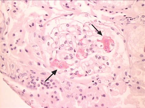 Congo red stain of renal tissue (400×), showing positive staining of... | Download Scientific ...