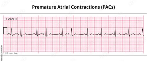 Premature Atrial Contractions (PACs) - Premature Atrial Complex (PAC ...