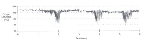 Overnight Pulse Oximetry And Its Use In The Diagnosis Of, 46% OFF