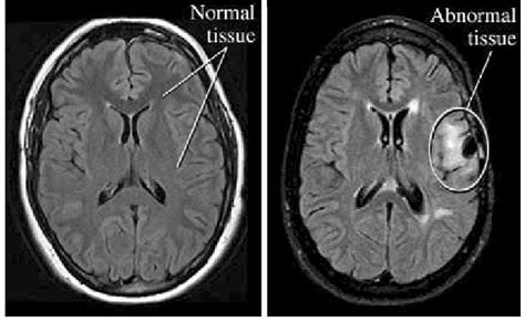 Normal and abnormal brain tumor. | Download Scientific Diagram