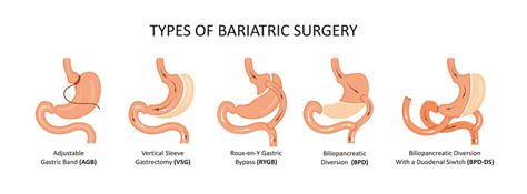 Pros And Cons Of Gastric Bypass Surgery, What To Consider When Deciding ...