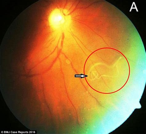 Parasitic Worm Found Inside Man's Eyeball (Photo)