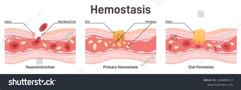 Hemostasis Wound Healing Process Stages Vasoconstriction Stock Vector (Royalty Free) 2190490517 ...