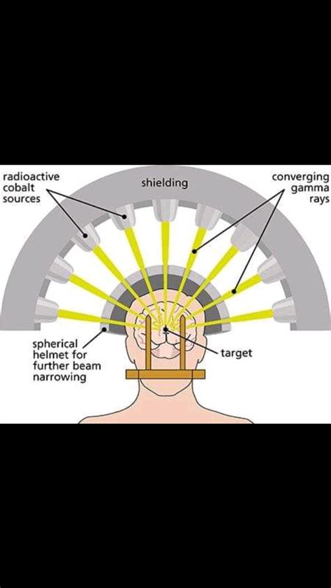 Abdallah Abdelrahman on LinkedIn: How it works All types of stereotaxic radiosurgery and ...