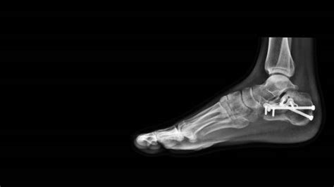 Film Ankle Xray Radiograph Showing Heel Bone Broken With Plate And ...