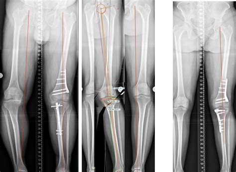 Osteotomy Surgery - Knee Surgery - Northern Knee Clinic