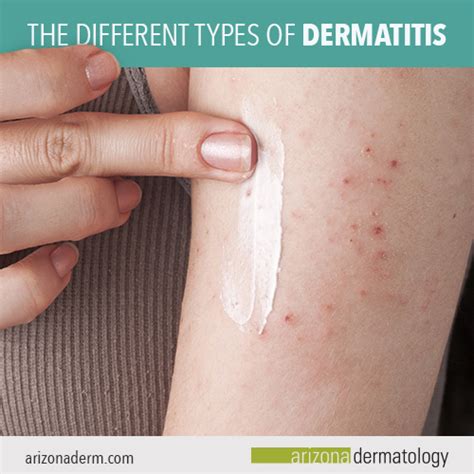 The Different Types of Dermatitis | Arizona Dermatology