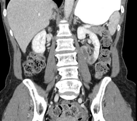 Renal infarction – Vascular Medicine – Angiologist