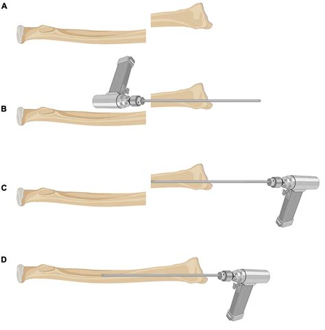 Frontiers | Limited Open Reduction and Transepiphyseal Intramedullary Kirschner Wire Fixation ...