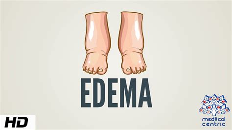 Edema: Causes, Symptoms, and Treatment | September 2023