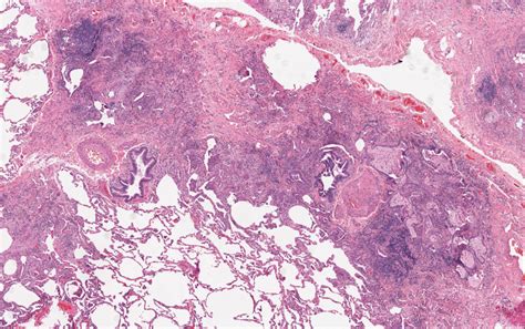 Interstitial Lung Disease Histology