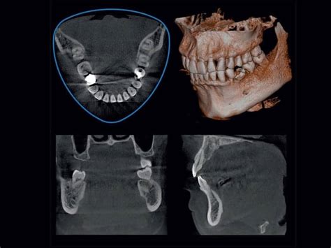 Is CT Scan Necessary For Dental Implants? | Dentist Norcross ...