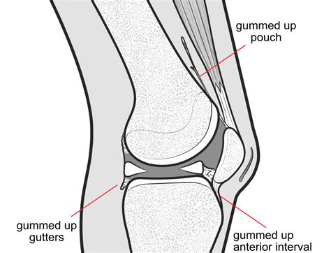 All about arthrofibrosis of the knee | KNEEguru