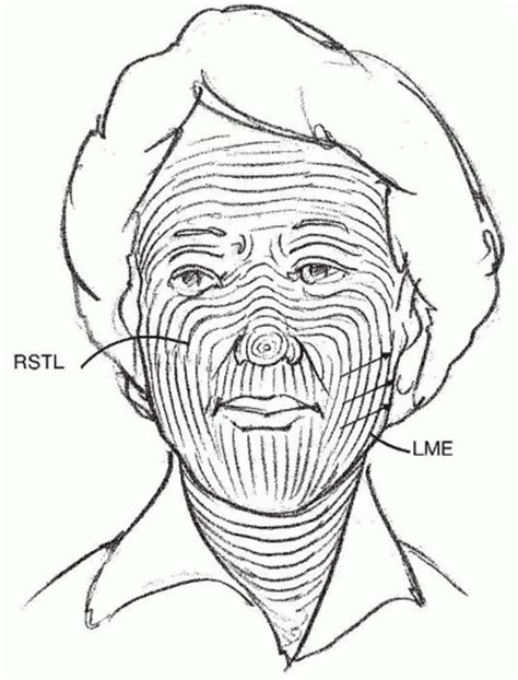 Local Cutaneous Flaps and Grafts | Ento Key