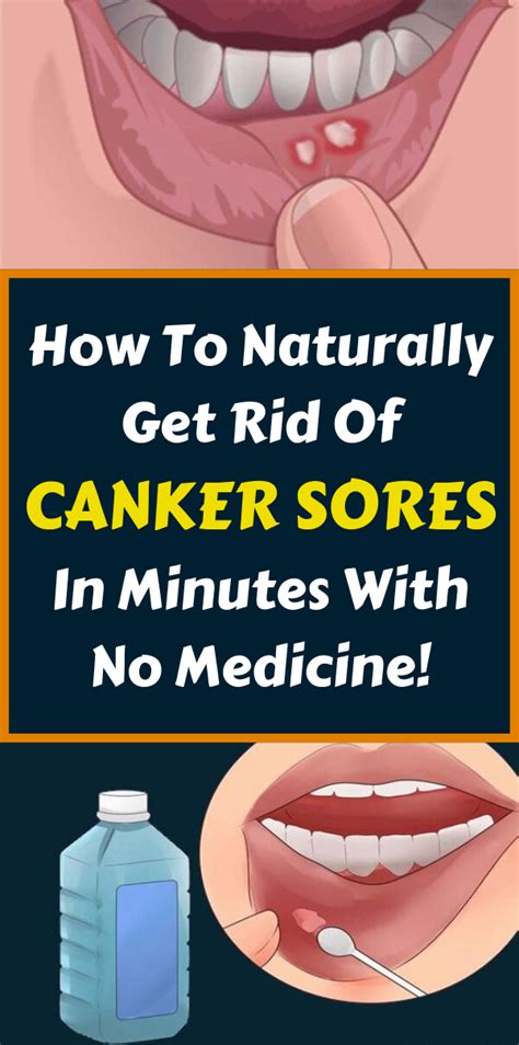 How to cure canker sores and mouth sores? | Remedy Day