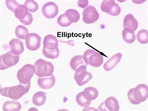 Hereditary elliptocytosis – Stepwards