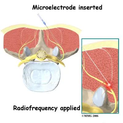 Facet Joint Radiofrequency Ablation Procedure | Padda Institute