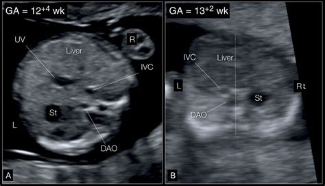 Fetal Cardiac Examination in Early Gestation | Obgyn Key