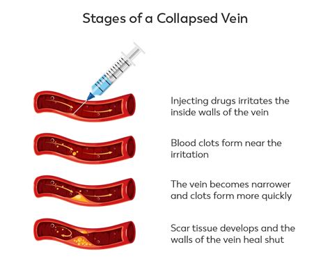 What is a collapsed vein? » Ask Our Doctors (by JourneyPure)