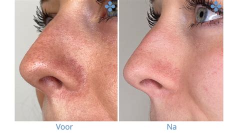 Couperose skin treatment The Hague and Oegstgeest | Van Lennep Kliniek