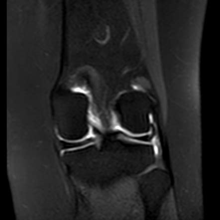 Normal MRI arthrography of the knee | Radiology Case | Radiopaedia.org