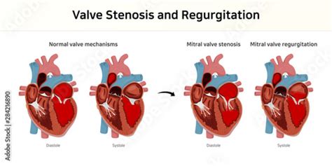 valve stenosis and regurgitation. valvular heart disease - Buy this ...