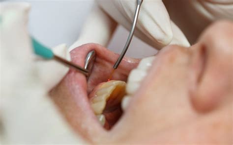 Things You Need to Know About Pinhole Gum Surgery | ndortho.com