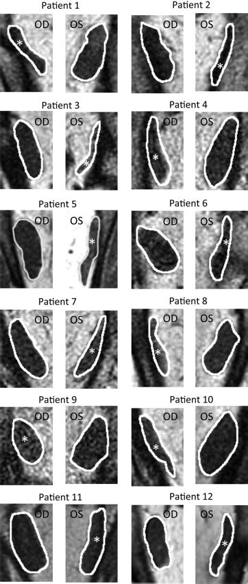 Lateral Rectus Superior Compartment Palsy | Ento Key