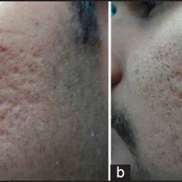 (a) Grade 4 acne scars; (b): Improvement in acne scars from Grade 4 to ...