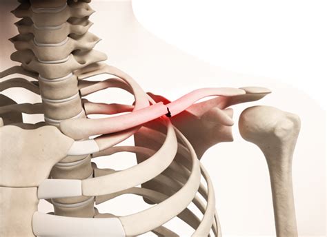 Clavicle Fracture (Broken Collarbone) - OrthoInfo - AAOS