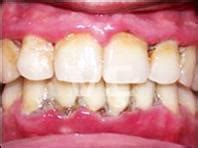 Crystal Lake Dental's Hot topics: A Gum disease form causing severe bad breath called NUG ...