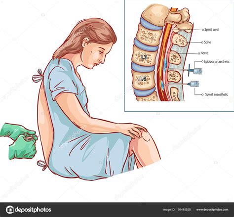 Epidural Nerve Block Injection Stock Vector Image by ©corbacserdar.gmail.com #199445528