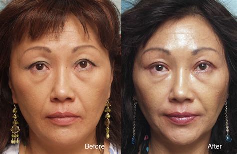 Asian-Eyelid-surgery-example-3-L - Steinsapir, Kenneth (lidlift.com)