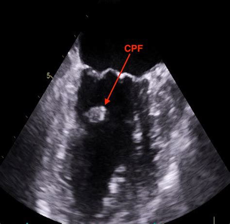 Cardiac Mass: A Case of Cardiac Papillary Fibroelastoma | Cureus