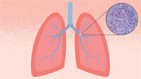 Lung Cancer Treatment