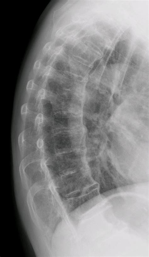 Diffuse idiopathic skeletal hyperostosis - Wikipedia