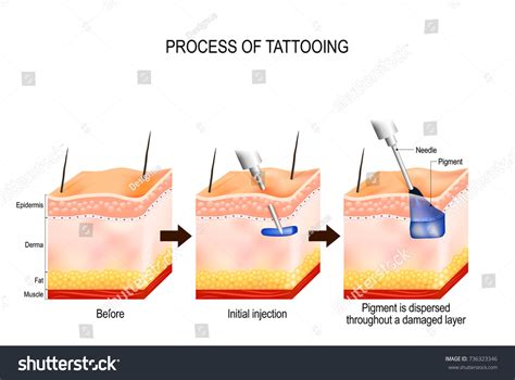 proceso tatuaje. El tatuaje causa daños: vector de stock (libre de ...