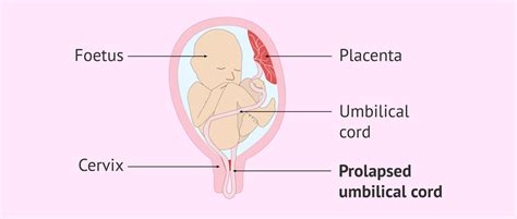 Prolapsed umbilical cord