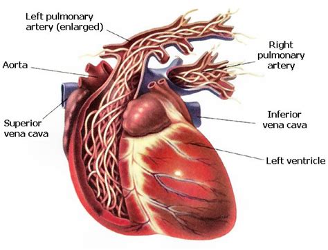 Heartworm in people | Worms & Germs Blog