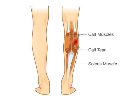 Calf Pain: Plantaris Tendon Rupture