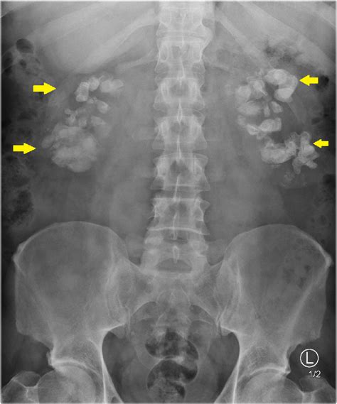 Abdomen (KUB View) Kidney, Ureter, And Bladder X-ray –, 40% OFF