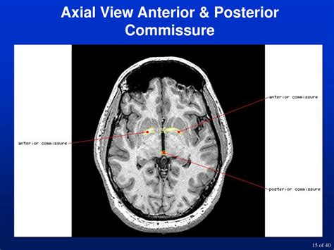 PPT - Lecture 4-Neuroanatomy Walter Schneider PowerPoint Presentation ...