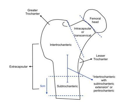 Types of hip fracture | Hip fracture, Medical education, Fractures