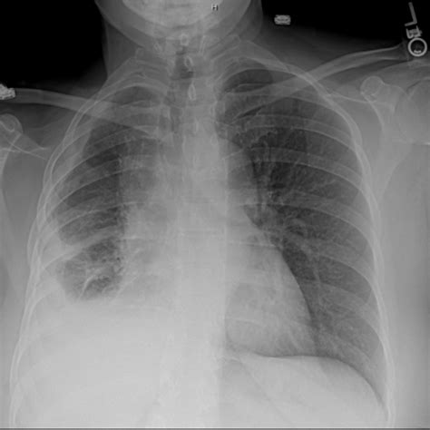 Malignant mesothelioma