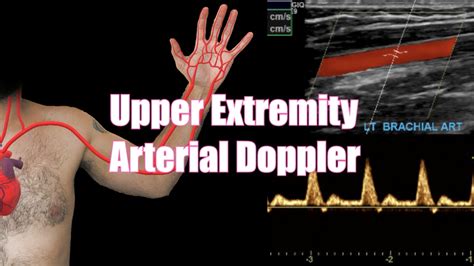 Arterial Duplex/Doppler Sonography of the Upper Extremities ...