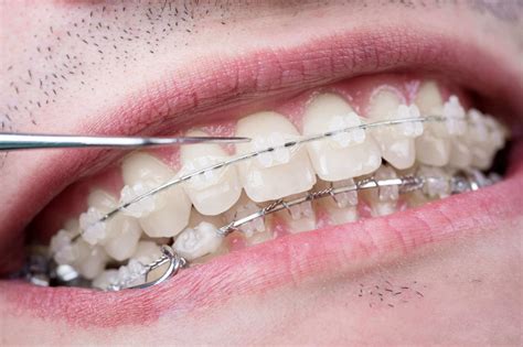 Aparelho dentário transparente em Londrina - Existe um aparelho dentário transparente?