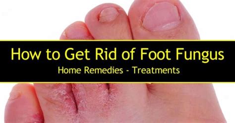 How to Get Rid of Foot Fungus – Home Remedies – Treatments