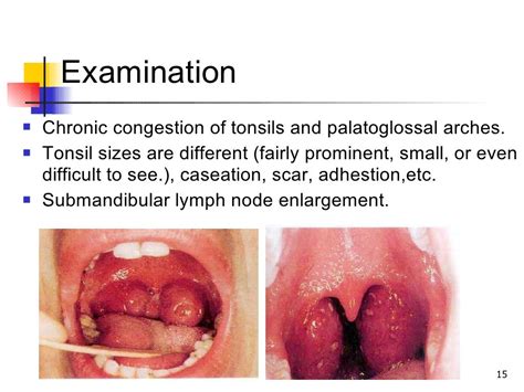 Acute and chronic tonsilitis