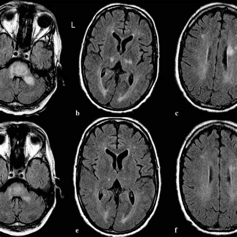 a–c T2-weighted MRI of the brain, demonstrating hyperintense lesions of... | Download Scientific ...