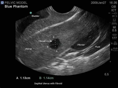 Transvaginal Ultrasound Fibroids